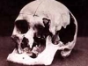 Andrew Borden\'s Skull